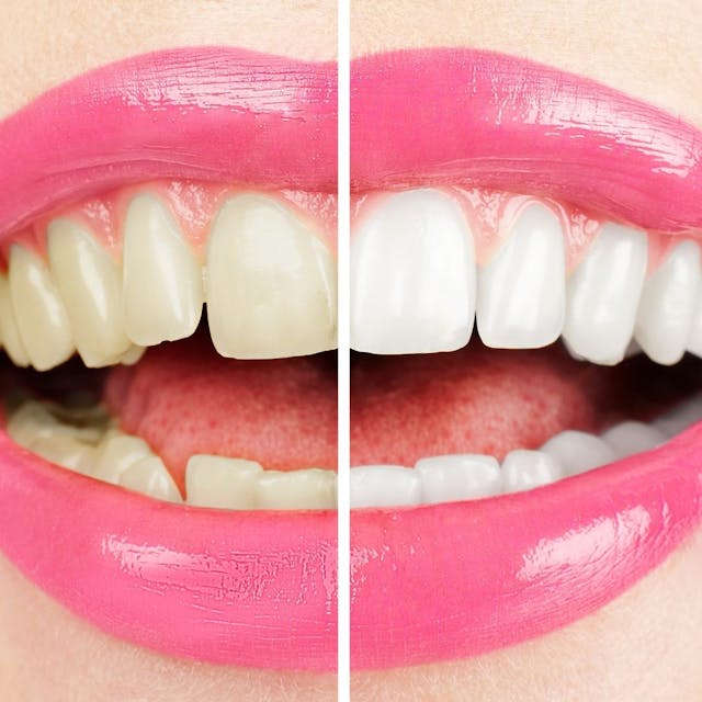 image of Uptodate Medicare Centres Teeth Whitening